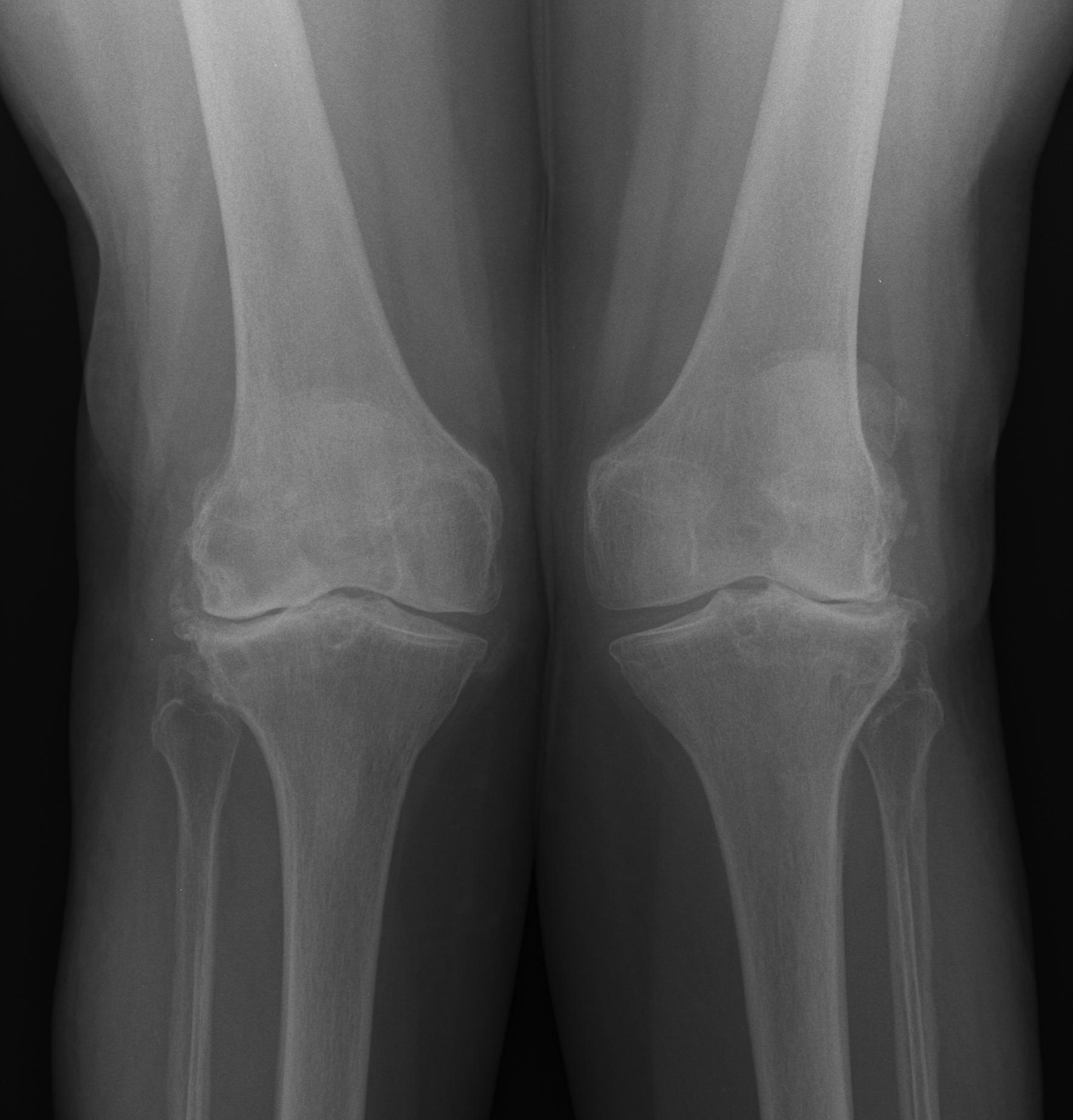Valgus knee